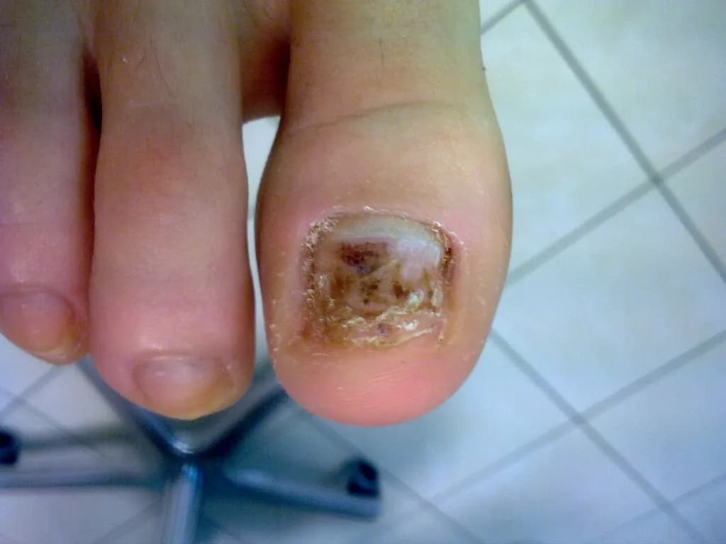 Odpadające paznokcie u nóg w snach: co oznaczają? Interpretacja